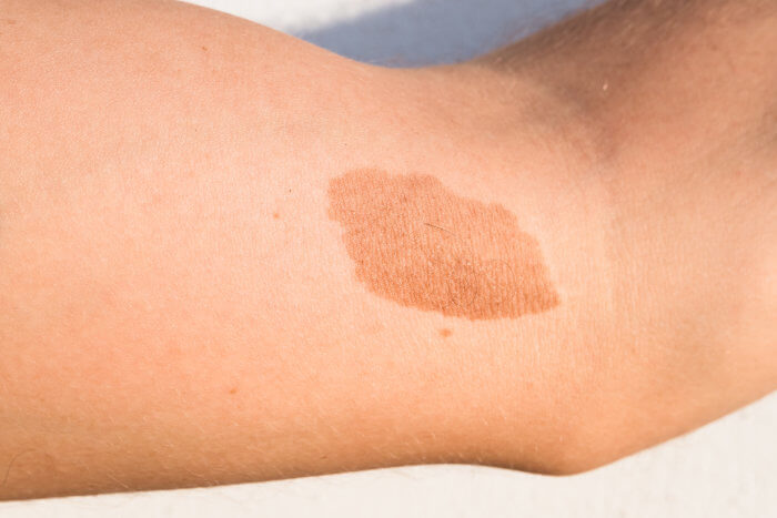 An example of a birthmark on human skin